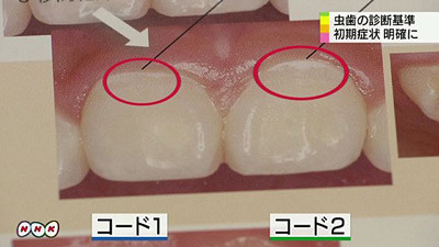 新基準の初期むし歯段階7分類