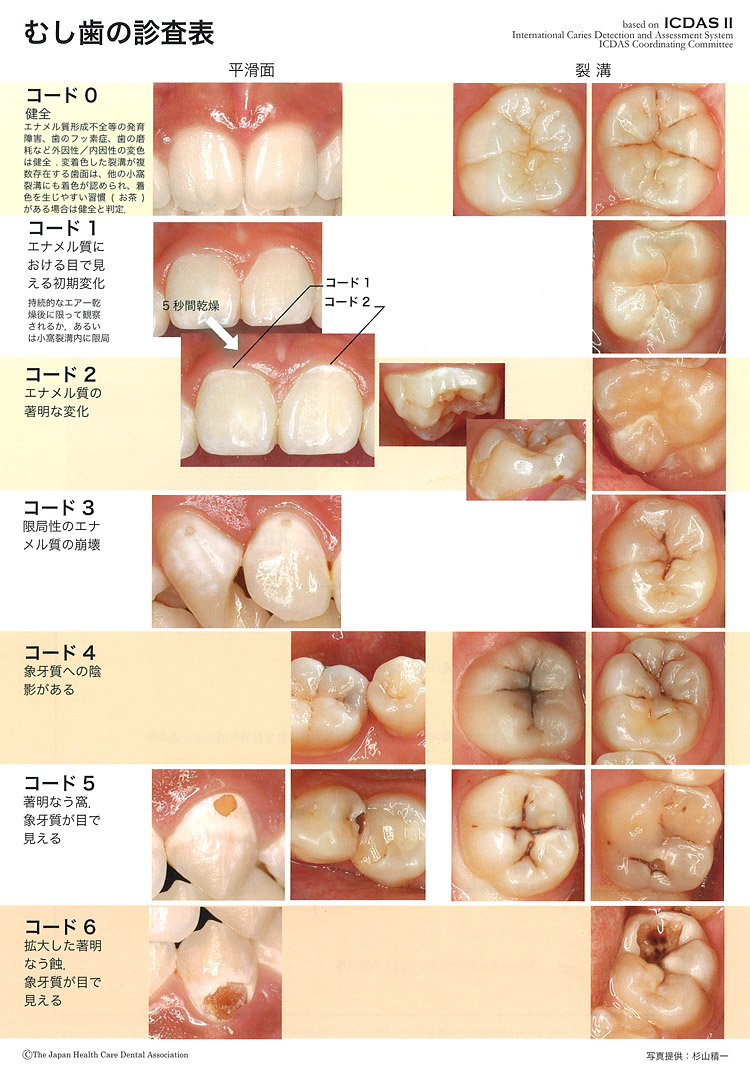 むし歯の診査表