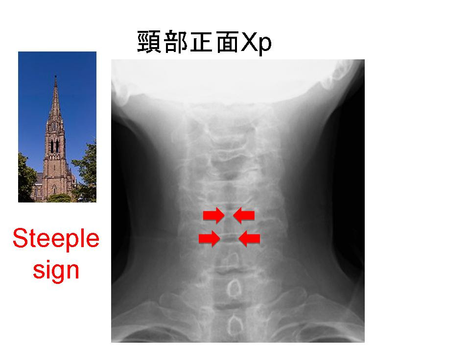 頸部感染症疑いは全例CTを 