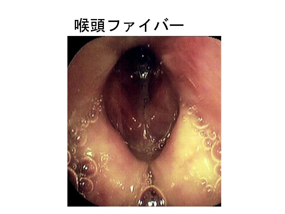 頸部感染症疑いは全例CTを 