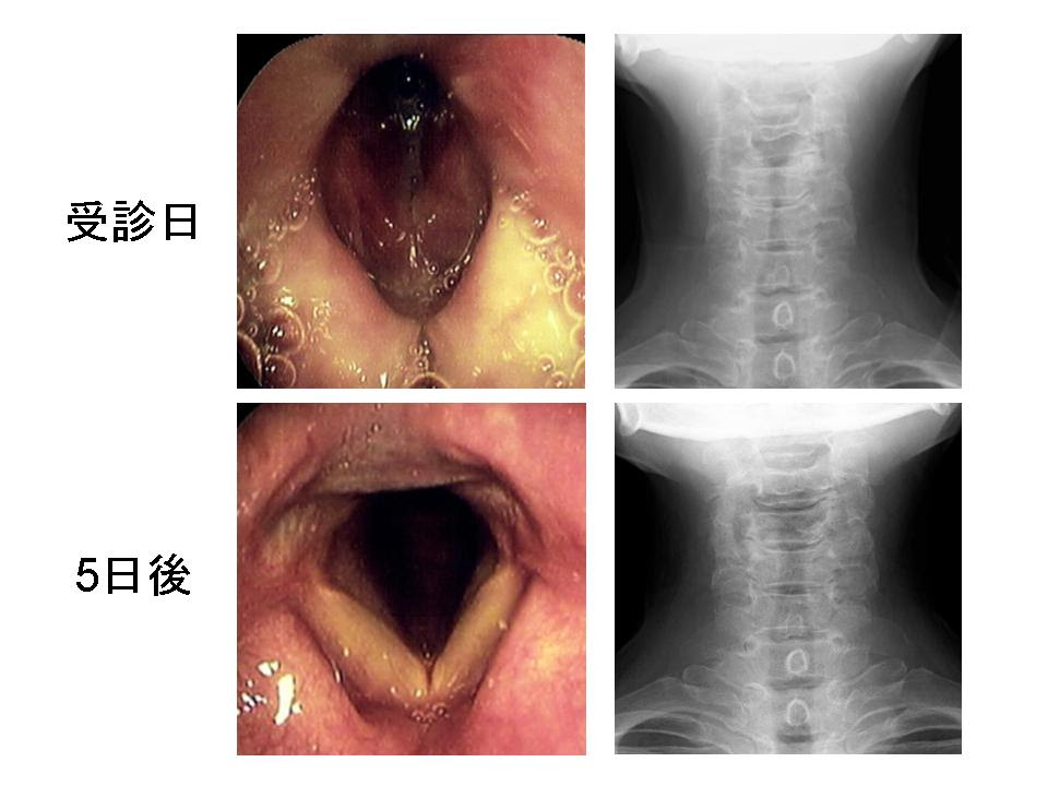 頸部感染症疑いは全例CTを 