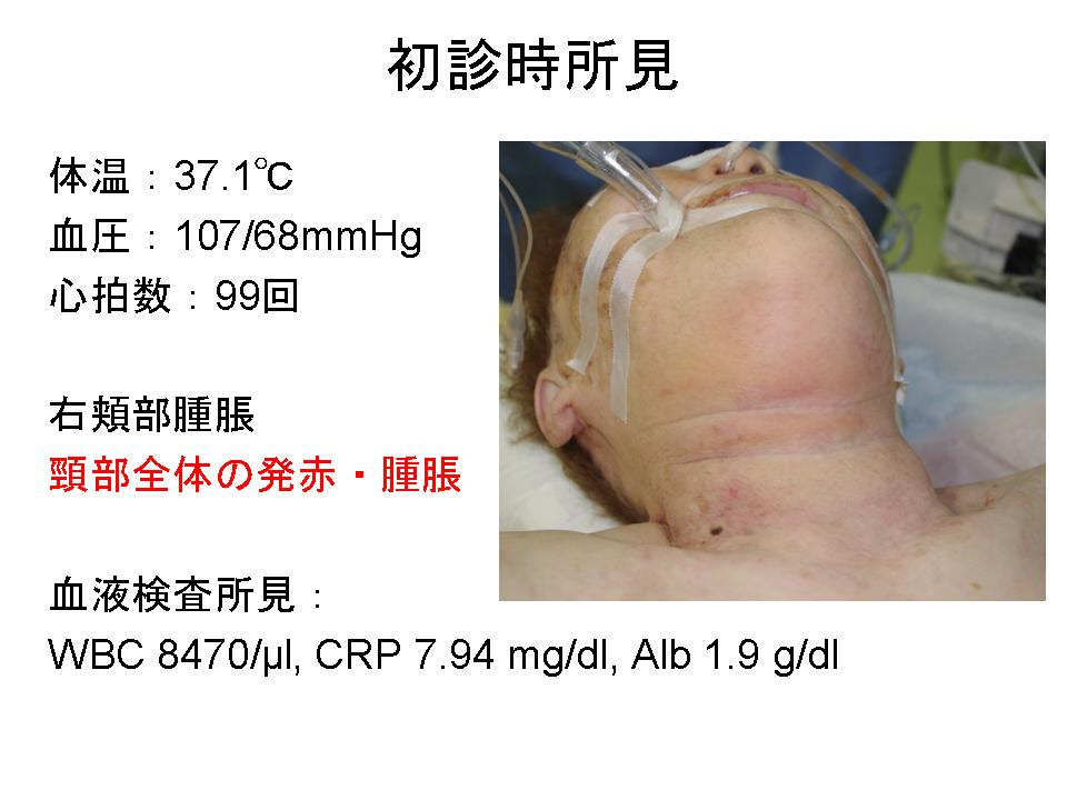 頸部感染症疑いは全例CTを 