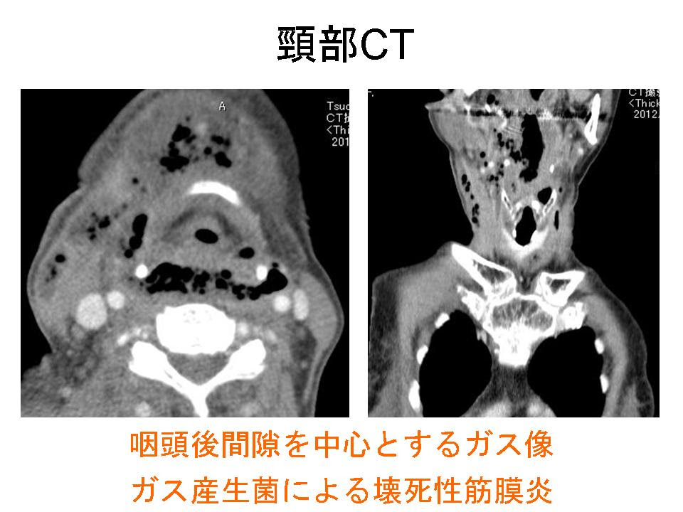 頸部感染症疑いは全例CTを 