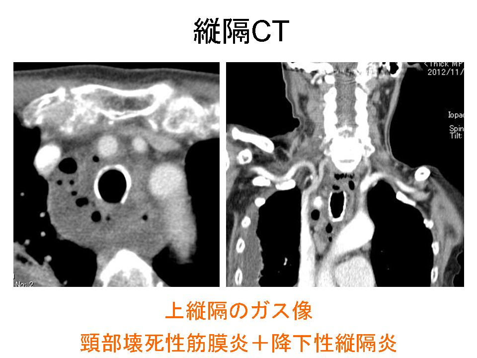 頸部感染症疑いは全例CTを 