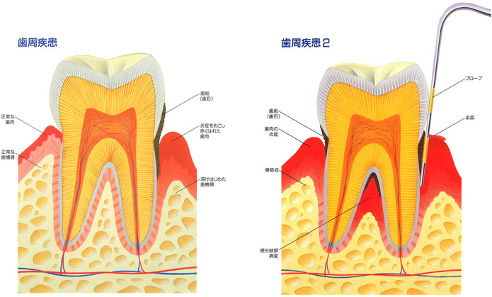 歯周疾患