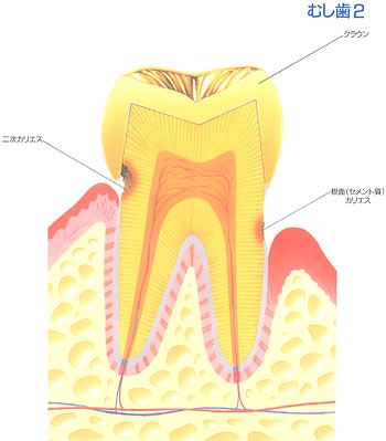 むし歯2