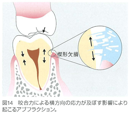 咬合力