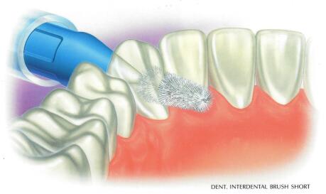歯間ブラシ