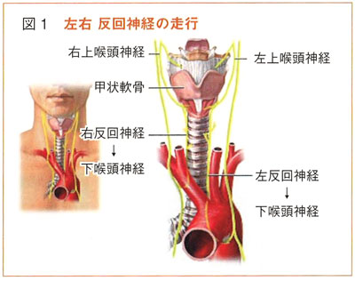 反 回 神経 麻痺
