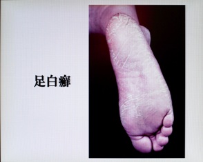 足白癬
