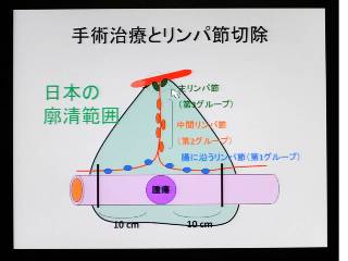 手術治療とリンパ節切除。