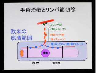 手術とリンパ節切除。