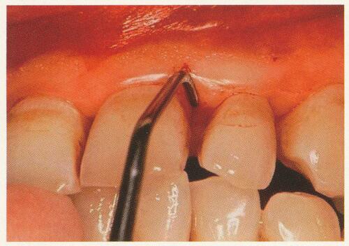 歯根の歯石や毒素の除去