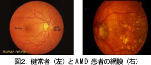図2健常者とAMD患者の網膜
