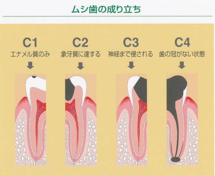 ムシ歯の成り立ち