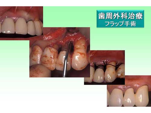 歯周外科治療＿フラップ手術