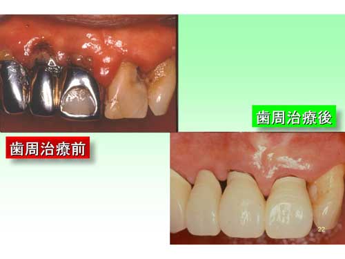 歯周治療の効果