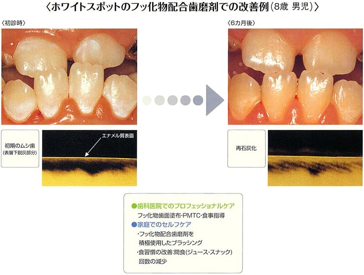 ホワイトスポットのフッ化物配合歯磨剤での改善例