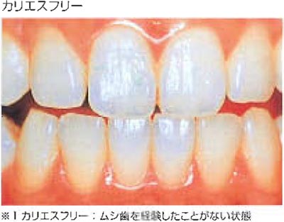 ムシ歯ができるのって、当たり前？