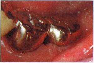 図14　左下歯周外科治療後。歯肉形態の変化がプラークコントロールを困難にする場合がある。