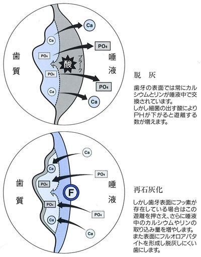 歯質の強化