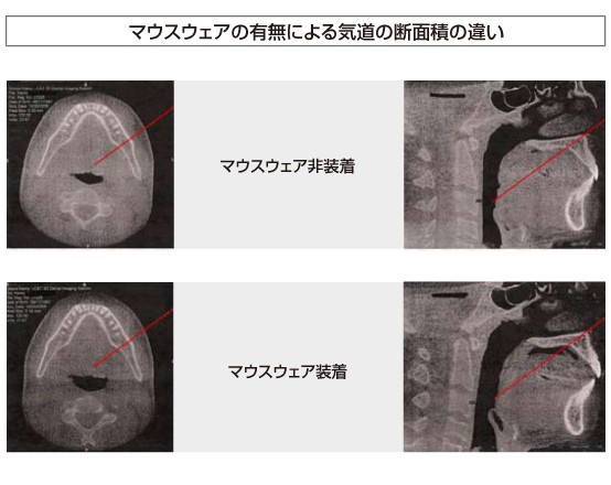 マウスウェアの有無による気道の断面積の違い