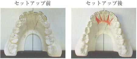 クリアアライナー