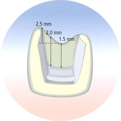 CEREC Blocs Preparatio