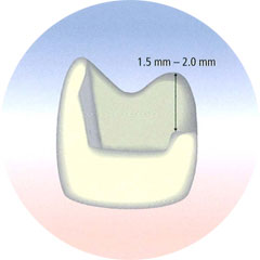 CEREC Blocs Preparatio