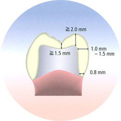 CEREC Blocs Preparatio