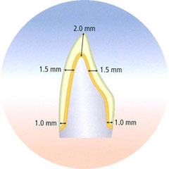 inCoris Preparation