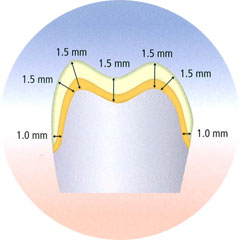 inCoris Preparation