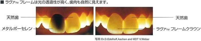 Lava TM Crowns and Bridges