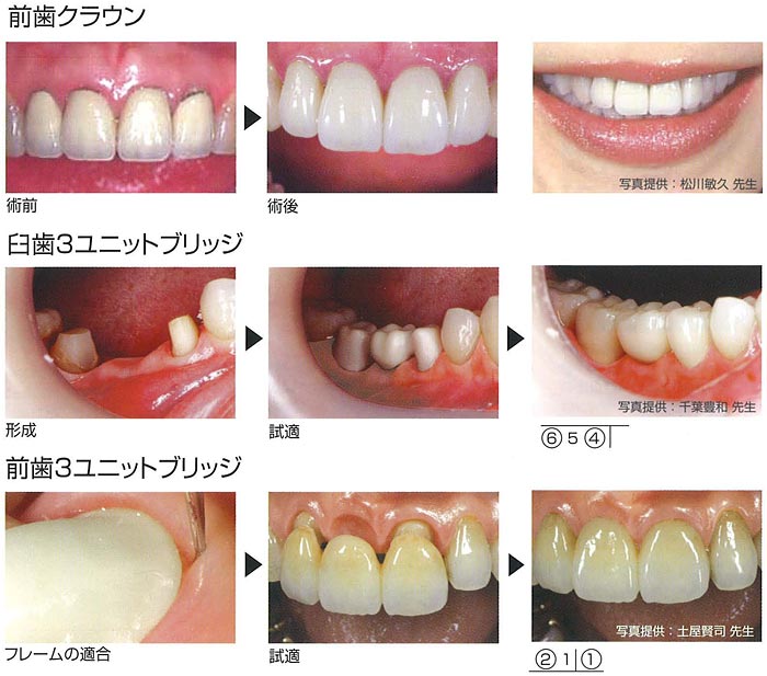 Lava TM Crowns and Bridges