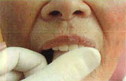 図3：リプロクリーンの中に汚れた義歯を入れ、超音波洗浄機にかける。