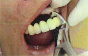 図2：右側大臼歯頬側部床縁が汚れている。