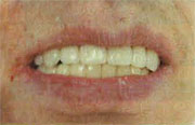 図2：右側大臼歯頬側部床縁が汚れている。