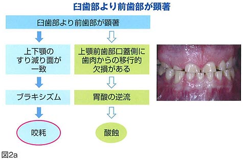 酸蝕症