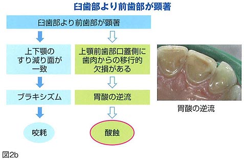 酸蝕症