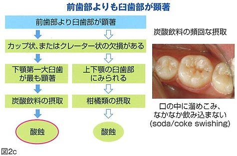 酸蝕症