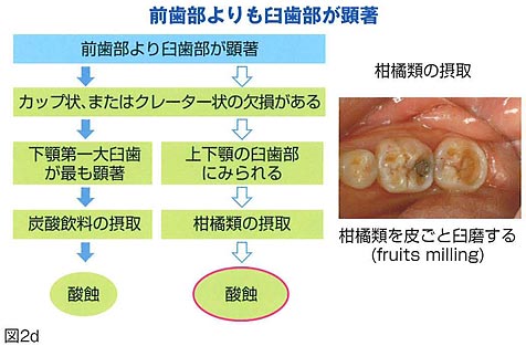 酸蝕症