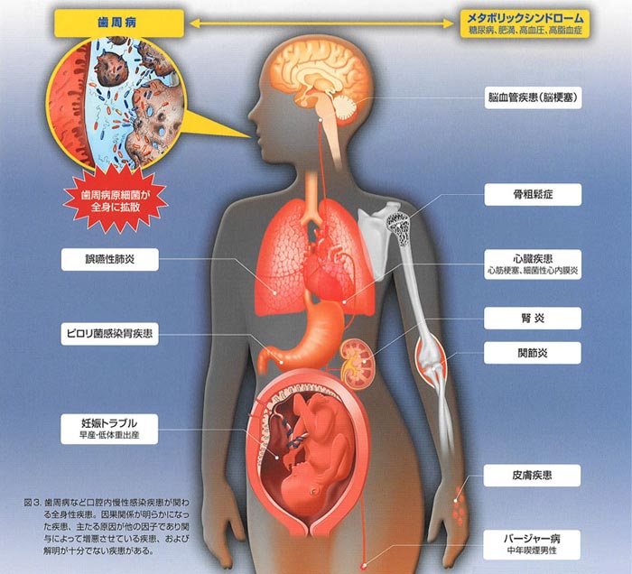 歯周病