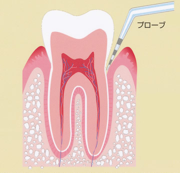 歯周病の検査方法（プロービング）