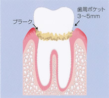 歯周病