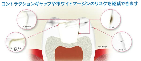 奥歯を埋めて治すと起こる医療不良