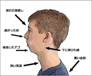 アデノイド顔貌図