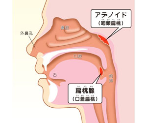 アデノイド顔貌図