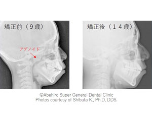 アデノイド顔貌図