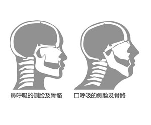 アデノイド顔貌図