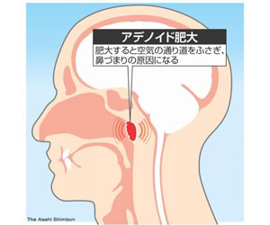 アデノイド顔貌図